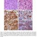 Langerhans cell sarcoma – a rare tumour diagnosed by histomorphology and immunophenotyping
